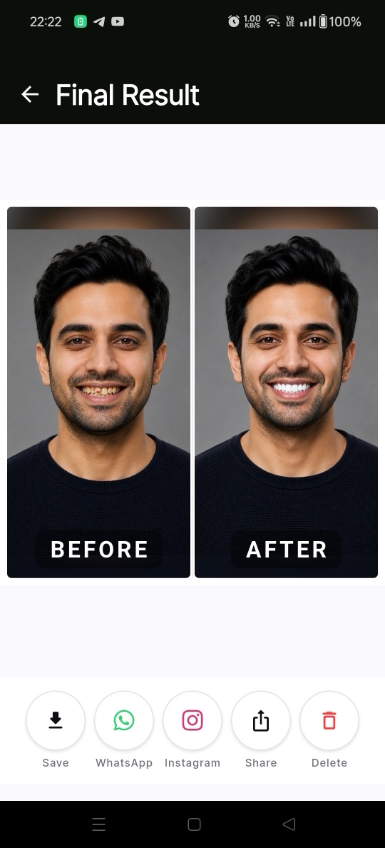 ProgressShot smile makeover before and after result